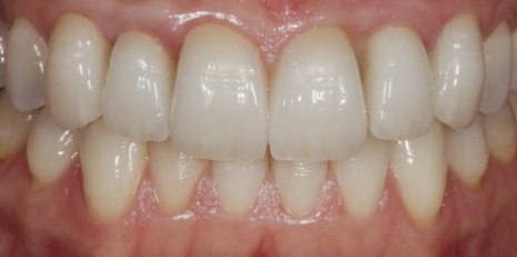 Close up of restored smile with a dental crown