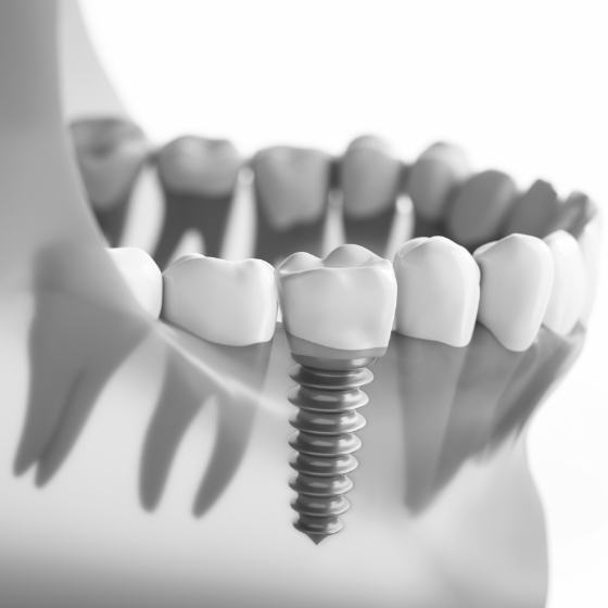 Illustrated dental implant with a dental crown