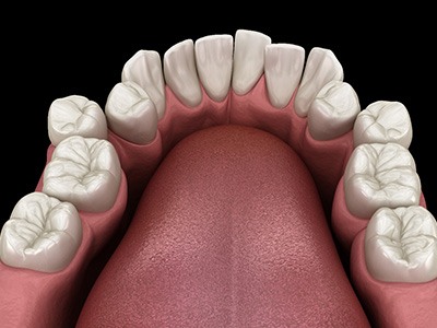 Illustration of crowded teeth