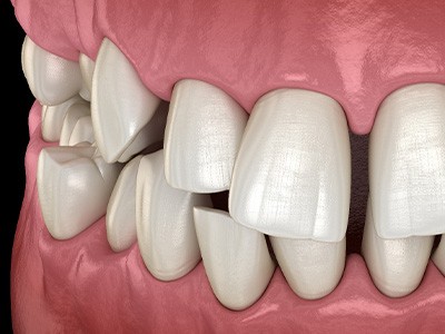 Illustration of gapped teeth