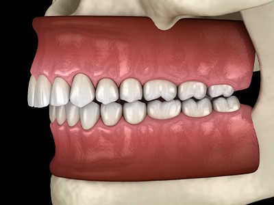 Illustration of an overbite