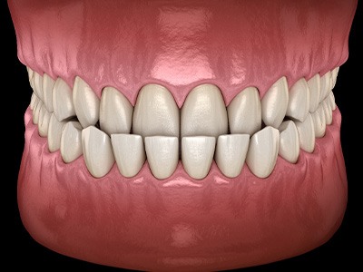 Illustration of an underbite