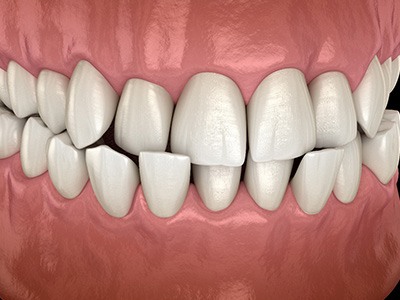 Illustration of a crossbite