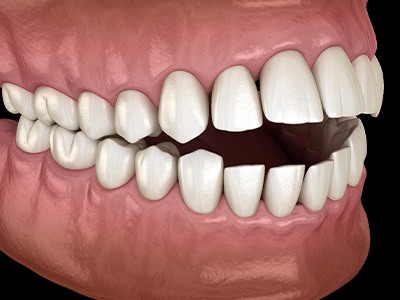 Illustration of an open bite