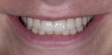 Close up of flawless smile with veneers