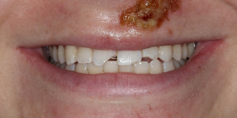 Close up of imperfect teeth before getting veneers