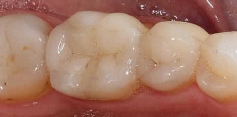 Close up of flawlessly restored teeth with inlays and onlays