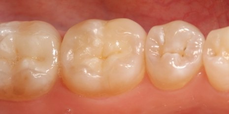 Close up of flawlessly restored teeth with inlays and onlays