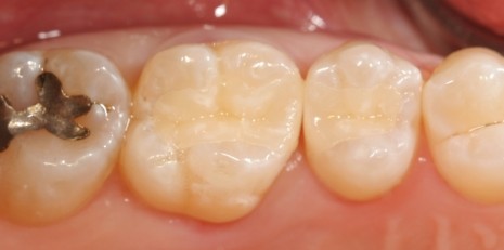 Close up of flawlessly restored teeth with inlays and onlays
