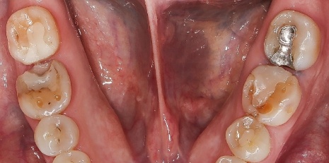 Close up of damaged teeth before ceramic dental inlays and onlays