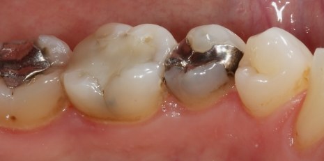 Close up of damaged teeth before ceramic dental inlays and onlays