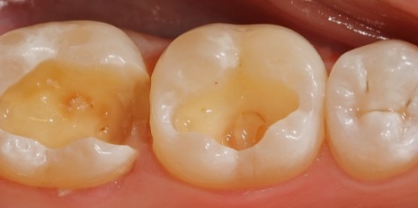 Close up of damaged teeth before ceramic dental inlays and onlays