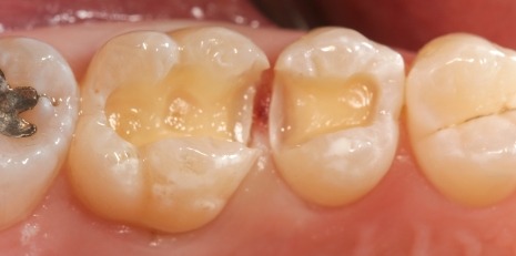Close up of damaged teeth before ceramic dental inlays and onlays