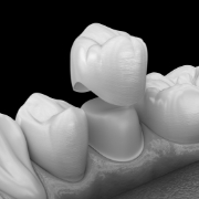 Illustrated dental crown being placed over a tooth