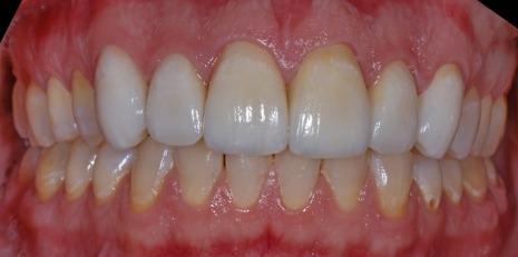 Close up of restored smile with a dental crown