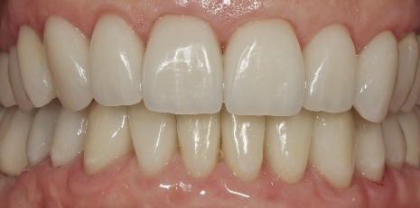 Close up of restored smile with a dental crown