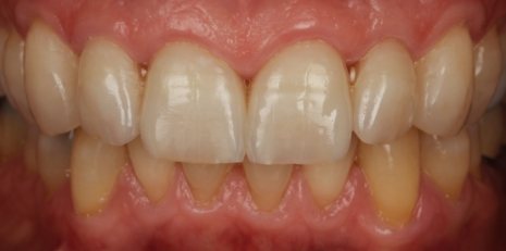 Close up of restored smile with a dental crown