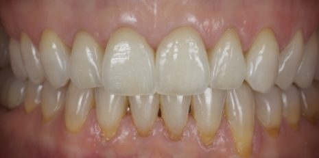 Close up of restored smile with a dental crown