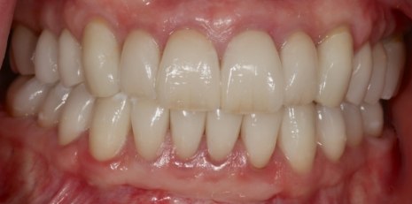 Close up of restored smile with a dental crown