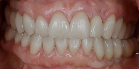 Close up of restored smile with a dental crown