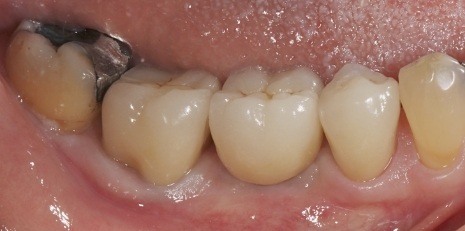 Close up of restored smile with a dental crown