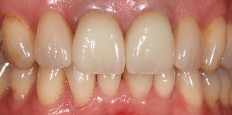 Close up of restored smile with a dental crown