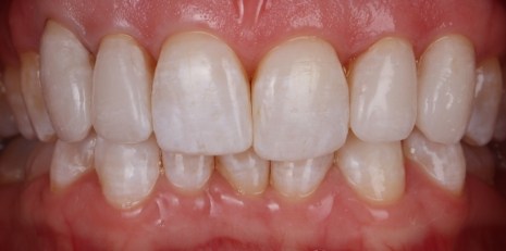 Close up of restored smile with a dental crown