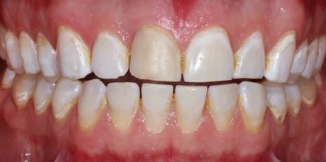 Close up of smile before receiving a dental crown