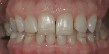 Close up of smile before receiving a dental crown