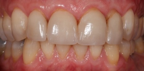 Close up of smile before receiving a dental crown