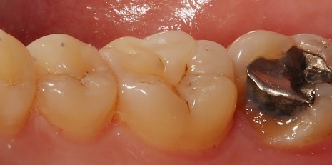 Close up of smile before receiving a dental crown