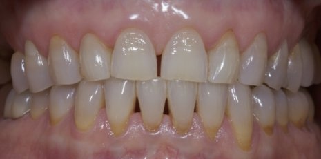 Close up of smile before receiving a dental crown