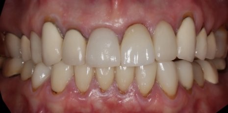 Close up of smile before receiving a dental crown