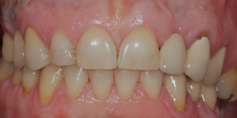 Close up of smile before receiving a dental crown