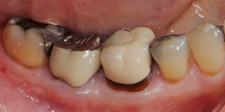 Close up of smile before receiving a dental crown