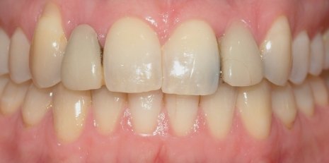 Close up of smile before receiving a dental crown