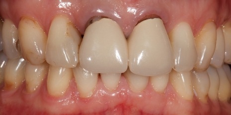 Close up of smile before receiving a dental crown