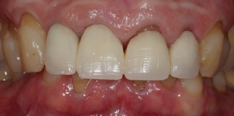 Close up of smile before receiving a dental crown