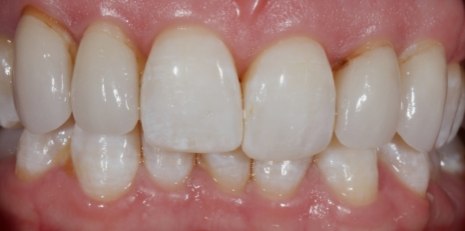 Close up of smile before receiving a dental crown