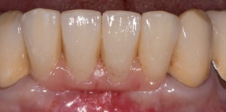 Close up of smile restored with a dental bridge