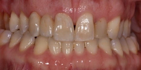 Close up of smile restored with a dental bridge