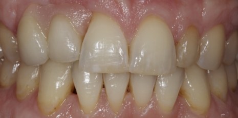 Close up of smile restored with a dental bridge