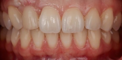 Close up of smile restored with a dental bridge