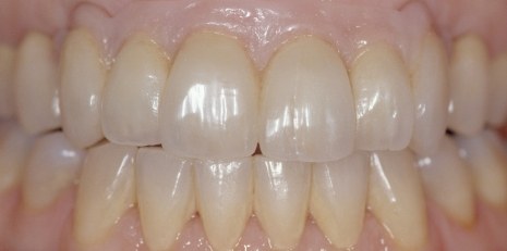 Close up of smile restored with a dental bridge