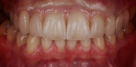 Close up of complete smile with dental implants