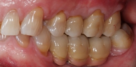 Close up of complete smile with dental implants