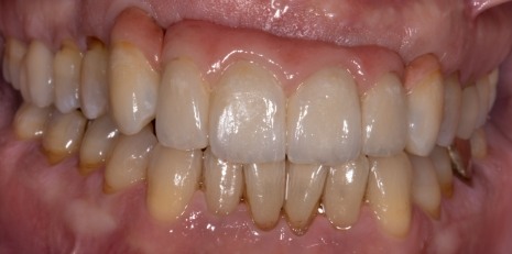 Close up of complete smile with dental implants