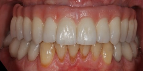 Close up of complete smile with dental implants