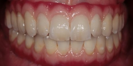 Close up of complete smile with dental implants