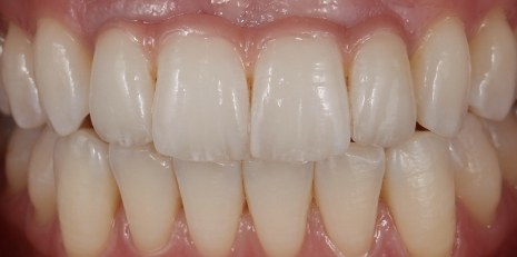 Close up of complete smile with dental implants